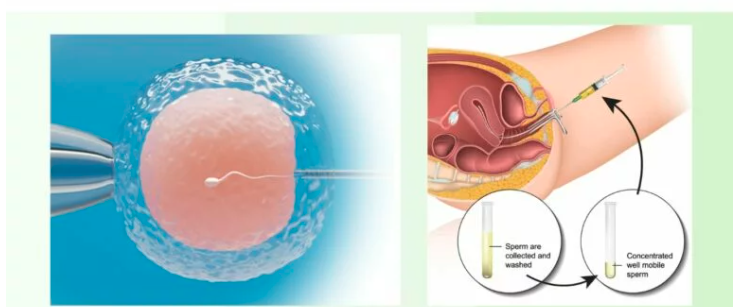 Intrauterine Insemination